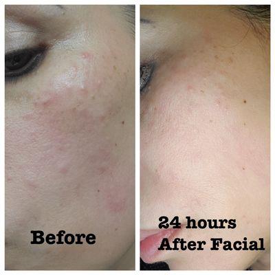 Clearer skin in 24 hours after the facial