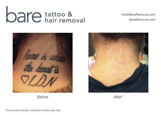 Laser tattoo removal results