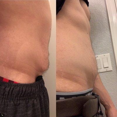 Loose skin after just 1 session of slimming!