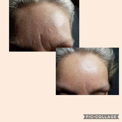 A safer alternative to Microneedling! These are the results of our Micro Peel Facial. Book now!!!