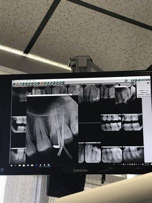 Molar that received 3x root canals by Dr. Salem