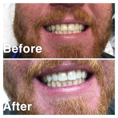 Before and After 1 hour LED Teeth Whitening - Teeth Whitening in Cooper City