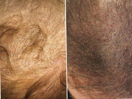 Thinning Hair