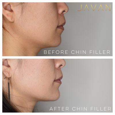 Subtle enhancements with chin filler