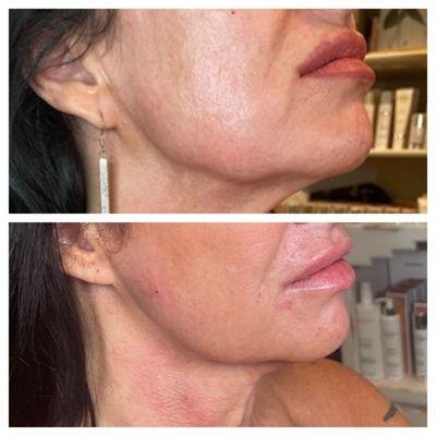 Improve jawline structure while building collagen with Radiesse