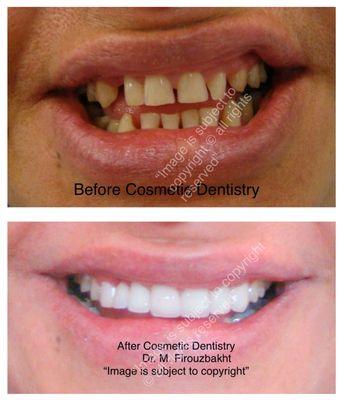 Cosmetic dentistry ,beautiful smile , before & after picture .CALL NOW (818)908-9199.