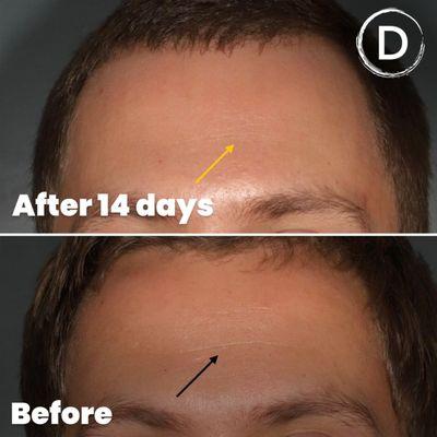 Early wrinkles treatment with Botox