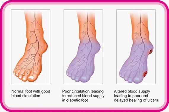 Diabetic foot care