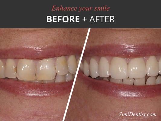 Enhance your smile from simple whitening to bonding to veneers and smile design!