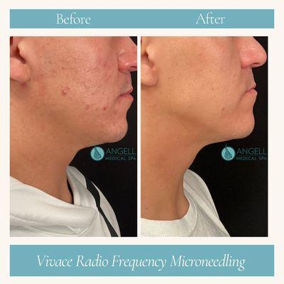 Vivace Radio Frequency Microneedling, Acne Scar Treatment, Skin Care