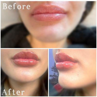 Restylane Lip Filler