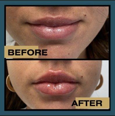 Before and after of lip filler!