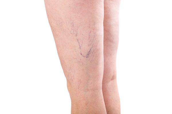 Spider veins symptoms