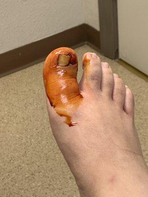 Toe Surgery.