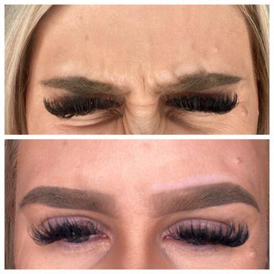 Glabella before/after Botox