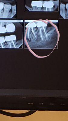 Infection in the jaw perforation of the root next to it gap in the crown harboring bacteria number 19 extracted post root canal retreatment