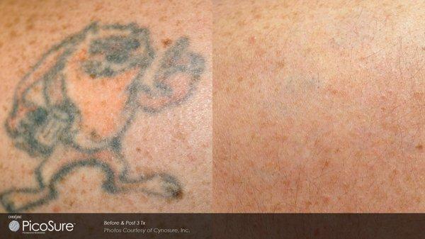 Our Pico Laser is #1 in tat removal