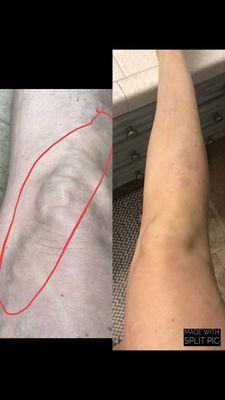 Treated with VenaSeal 24 hours later