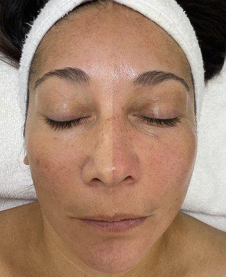 Before and after side-by-side of a hydrofacial