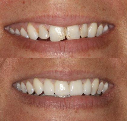 Broken composite bonding replaced with veneers