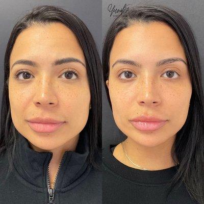 A contoured, refreshed, and balanced look for this beautiful babe! Treatment: Cheek, Jawline, Lip and Chin Filler.