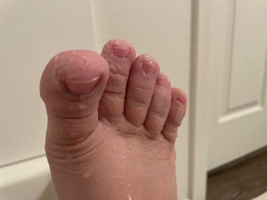 Mutilated feet after my $50 pedicure.