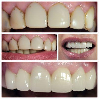 Before and After.
6 front metal free zirconia with facial porcelain crowns