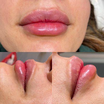 Lip fillers