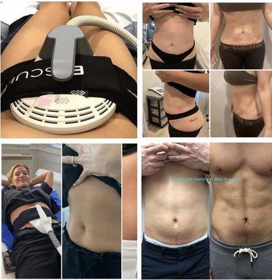 Emsculpt: 20,000 crunches in 30 minutes!