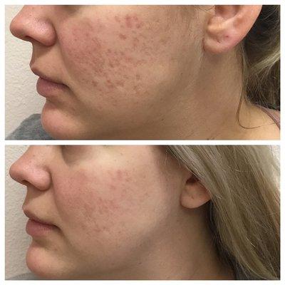 Before and after 3 microneedling treatments