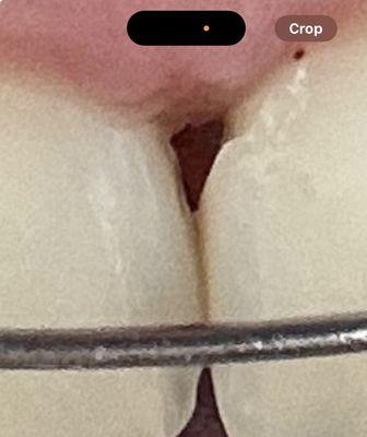 The space I was left with after my front tooth was damaged during my cleaning.