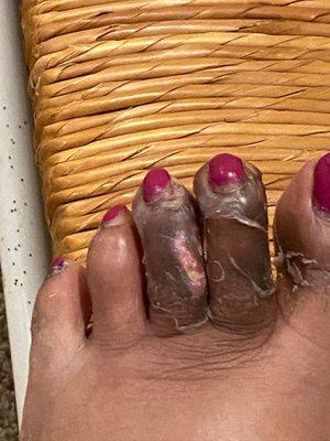 Infected due to heater burn at Regal nail salon