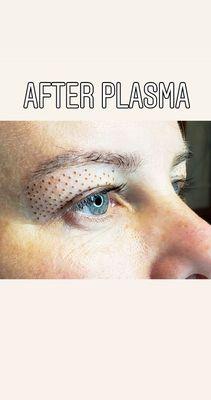 Upper eyelid lift using plasma pen treatment