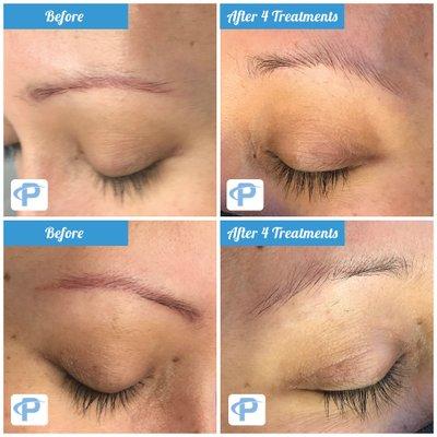 Eyebrow laser removal. Complete removal after 4 treatments.