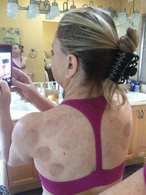 Cupping