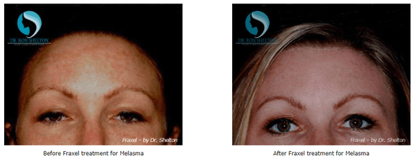 Melasma treatment before and after