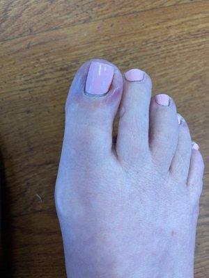 Pedicure infection