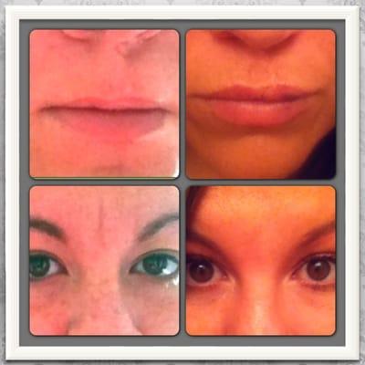 My before and after. Restylane fillers in forehead and top lip.