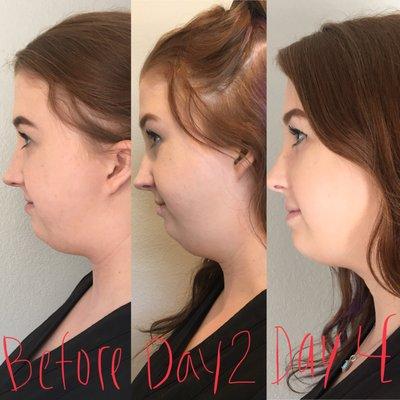 My awesome KYBELLA results.