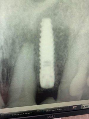 Implant #2