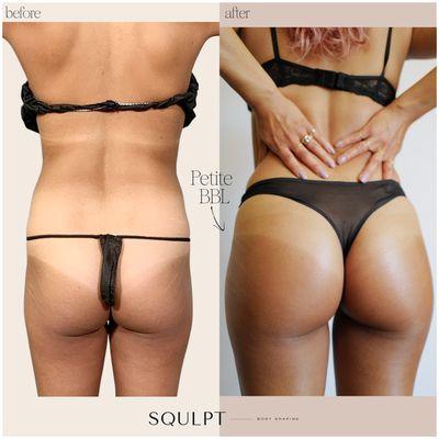 Petite BBL™ (450 cc/side) + SoftSqulpt™ awake liposuction to abdomen, waist & hips, and lower back - Before & After Result!