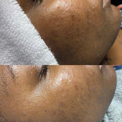 Before and After Neon Gold Brightening Facial