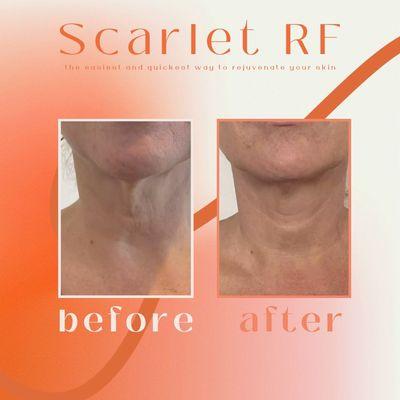 Before and after - Scarlet RF microneedling