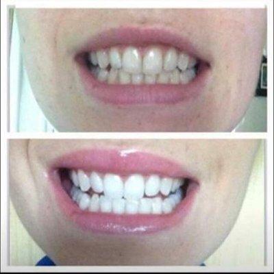 All it takes is under 30 mins. for a beautiful whiter smile!