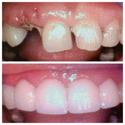 Porcelain crowns and bridge after cosmetic gum reshaping