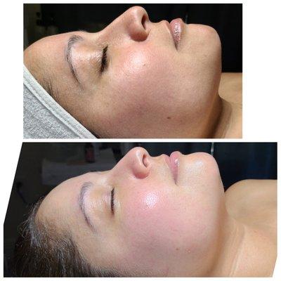 Microdermabrasion Facial