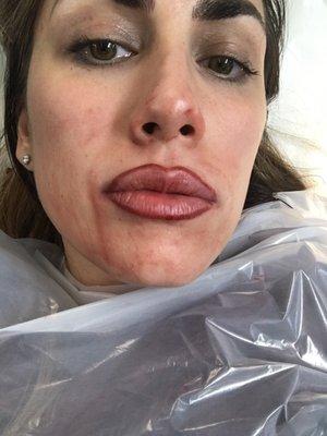 During . Ouch ! Getting your lips repeatedly needled is no joke.