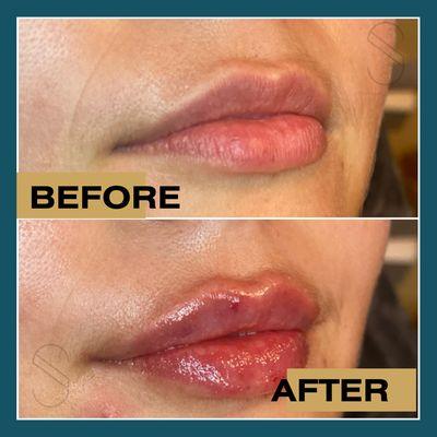 Before and After Lip Filler at Spindrift Aesthetics