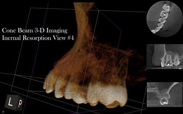 Forth view of a Cone Beam 3-D image of Internal Root Resorption