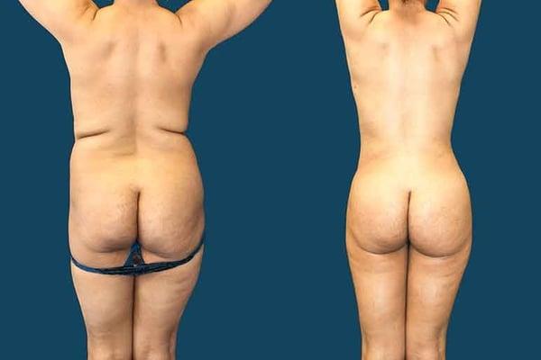 posterior view, the narrowing of the waist is evident as well as the gluteal fat transfer volume. Natural and permanent.